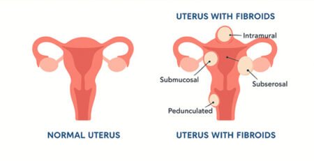 Fibroid uterus