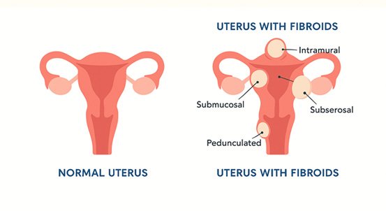 Fibroid uterus