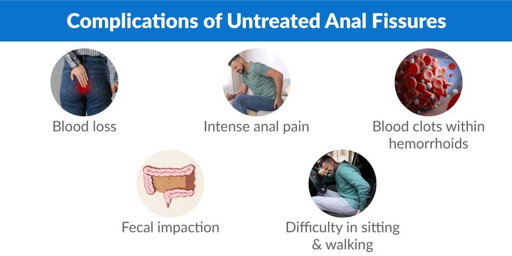 Complications of Untreated Anal Fissures - Fissure in Ano Treatment: Painless Laser Surgery & Expert Care in Ghaziabad & Delhi NCR fissure