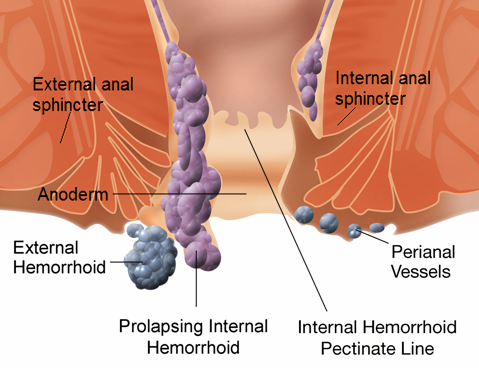 Suffering from piles or hemorrhoids? Learn about painless treatment for piles. 1 Internal and external hemorrhoids 1 - Suffering from piles or hemorrhoids? Learn about painless treatment for piles. piles