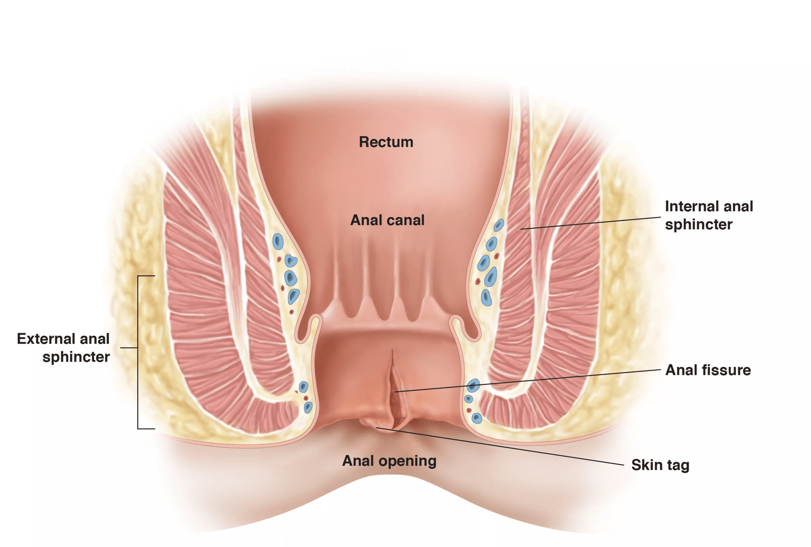 figure1 anal fissure final.jpg scaled - Fissure in Ano Treatment: Painless Laser Surgery & Expert Care in Ghaziabad & Delhi NCR fissure