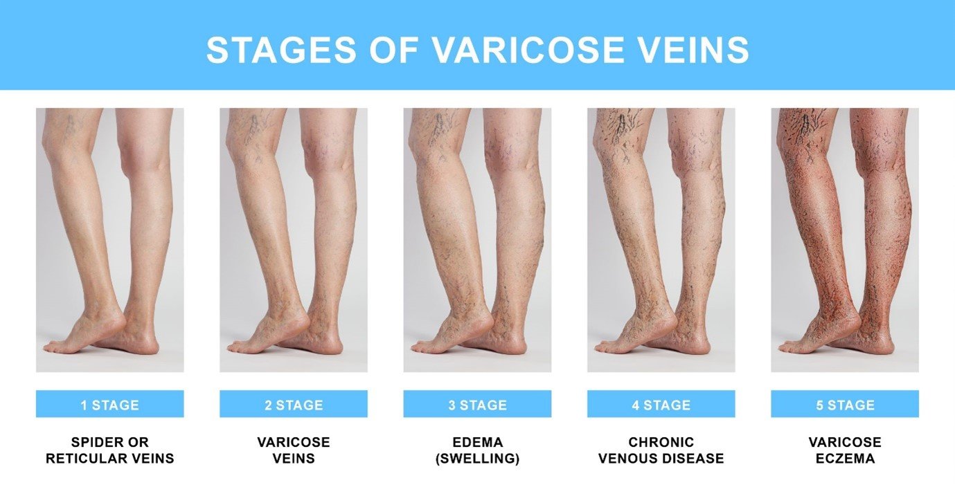 stages of varicose - Varicose Veins : Don't Let Them Slow You Down varicose veins