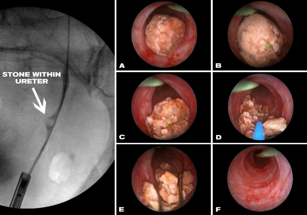 Kidney Stones: When is Surgery Needed? 2 ursl - Kidney Stones: When is Surgery Needed? kidney stone