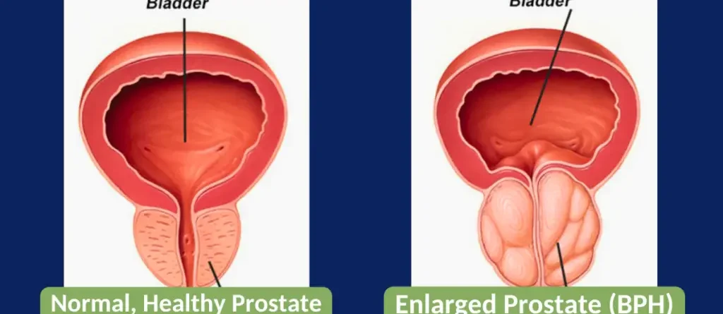 bph, enlarged prostate