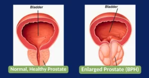 bph, enlarged prostate