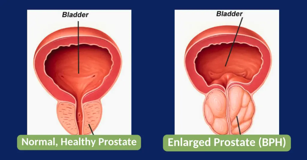 bph, enlarged prostate