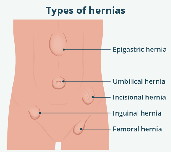 Picture1 - Demystifying Hernia HERNIA
