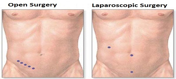 Picture3 - Demystifying Hernia HERNIA