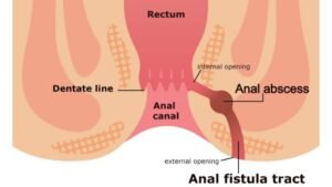Interactive Guide to Liver Health 6 fistula in ano, fistula,