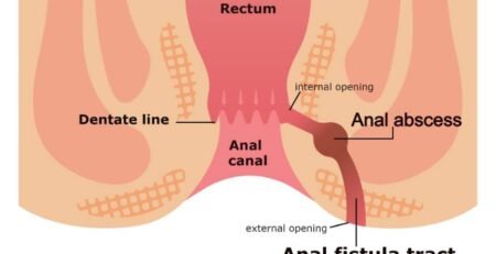 fistula in ano, fistula,