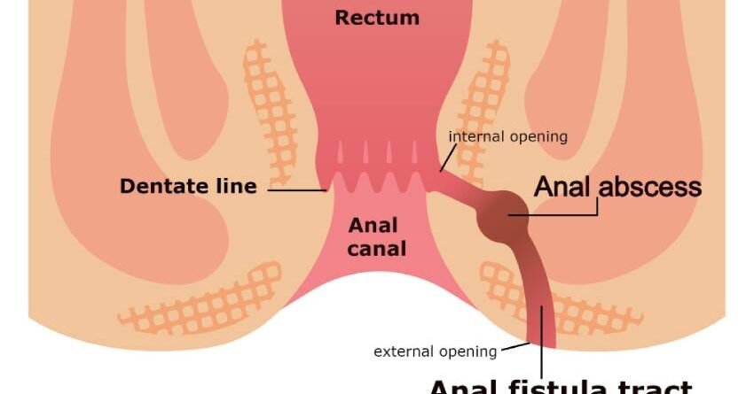 fistula in ano, fistula,