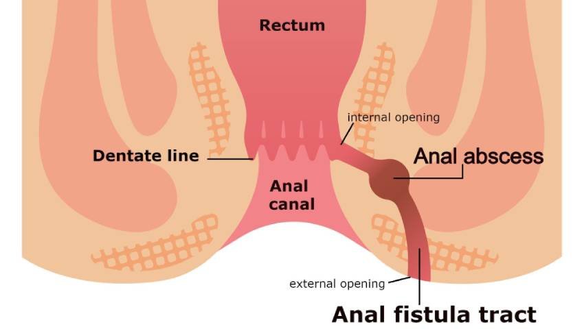 fistula in ano, fistula,